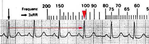 EKG Seminar: Bestimmung der Herzfrequenz